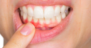 entzündetes Zahnfleisch Hausmittel