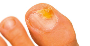 Nagelpilz Hausmittel