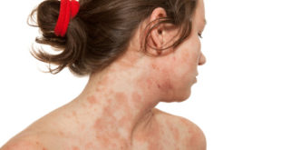 Neurodermitis Hausmittel