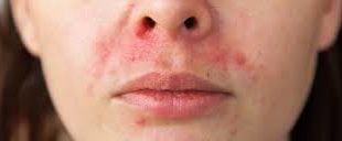 periorale Dermatitis