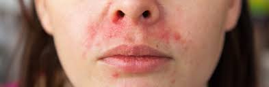periorale Dermatitis Behandlung Hausmittel