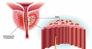 prostataentzuendung Hausmittel